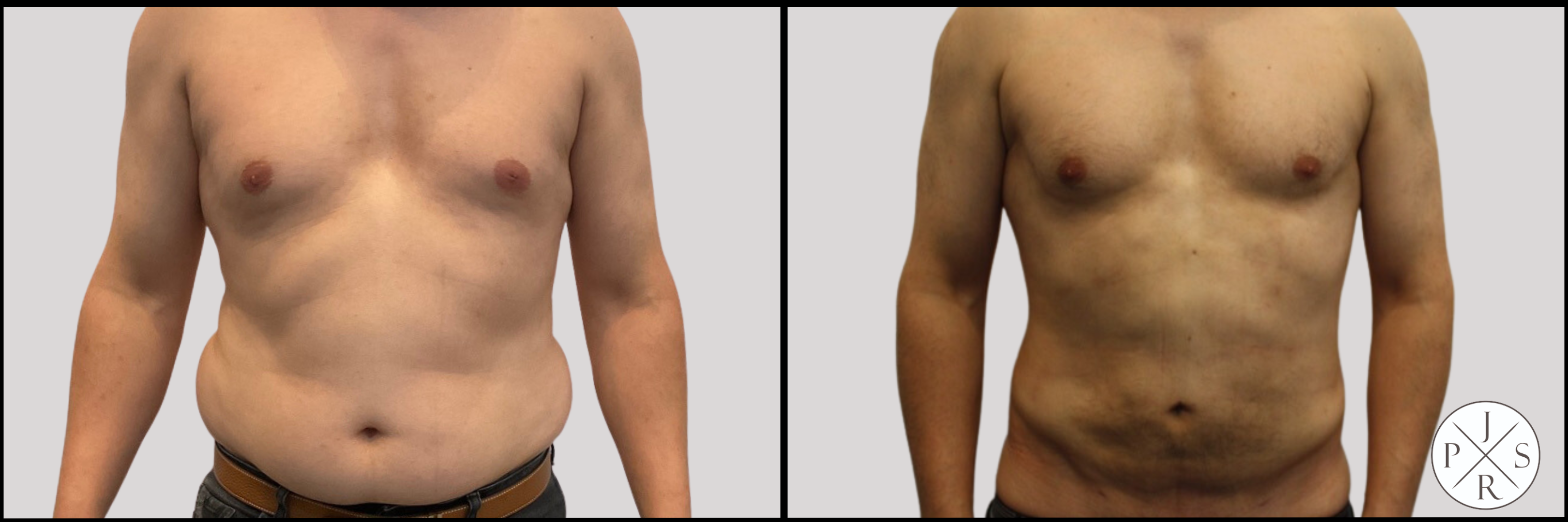 Liposuction Before & After Image